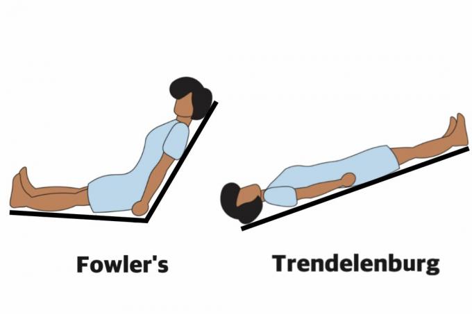 Fowler's e Trendelenburg