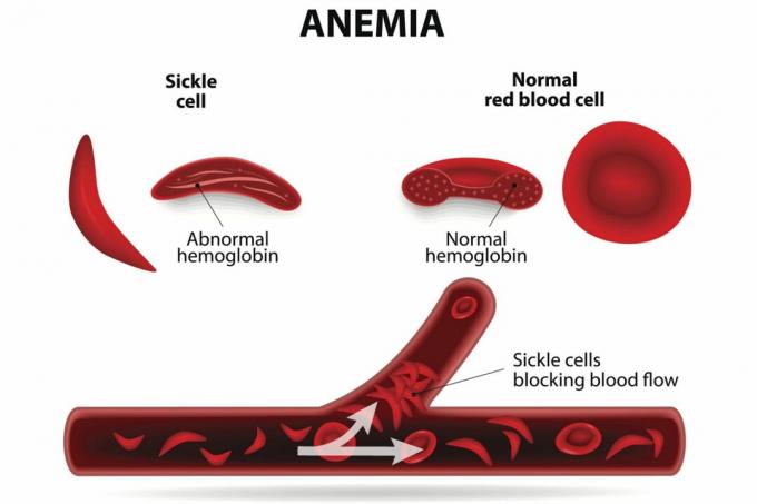 Anemia Falciforme